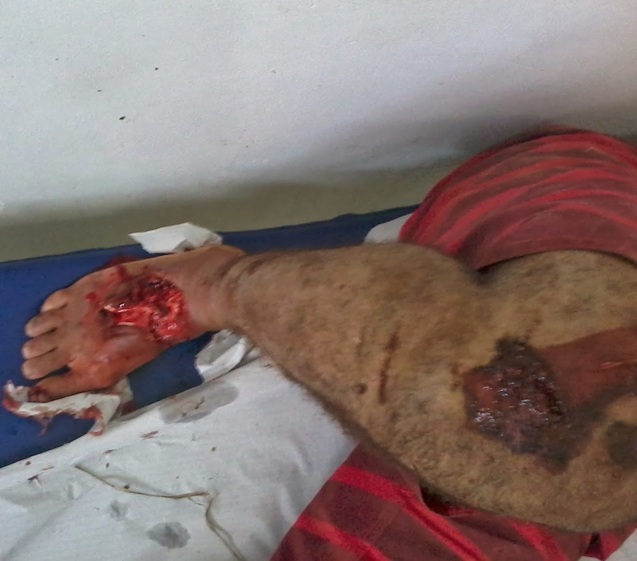 Ciclista é atropelado na estrada do feijão, em Ipirá