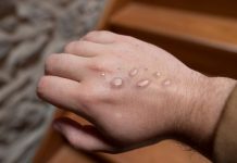 Itaberaba e Boa Vista do Tupim registram casos suspeitos de Monkeypox