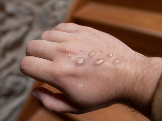 Itaberaba e Boa Vista do Tupim registram casos suspeitos de Monkeypox