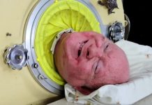 Homem que viveu com pulmão de ferro por 70 anos morre de covid