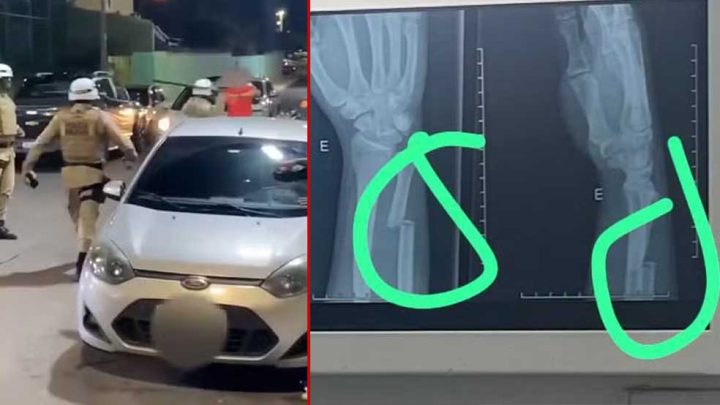 Familiares dizem que jovem teve braço fraturado após agressão de policiais na Bahia