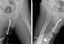 Homem é internado após inserir escova de dentes em Órgão Genital Homem é internado após inserir escova de dentes em Órgão Genital