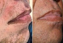 Homem com 98% do corpo com vitiligo termina o relacionamento, e manchas somem