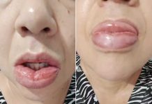 Mais de 1.200 pessoas relataram reação a pasta da Colgate; venda segue proibida