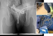 Homem é internado após enfiar cabo USB no pênis e objeto ficar preso Homem é internado após enfiar cabo USB no pênis e objeto ficar preso