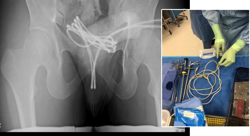 Homem é internado após enfiar cabo USB no pênis e objeto ficar preso