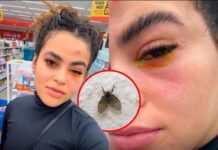 Mosca de banheiro entra no olho de influenciadora e causa infecção