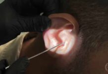 Pesquisa aponta que cera de ouvido pode ajudar a detectar câncer