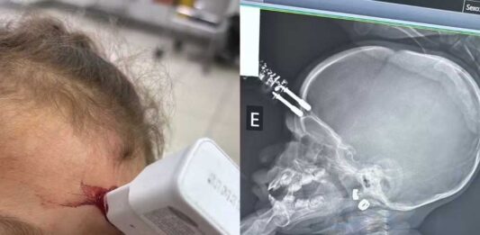 Menina de 1 ano fica com carregador cravado na testa após cair da cama Menina de um ano fica com carregador de celular cravado na testa após cair da cama em Divinópolis