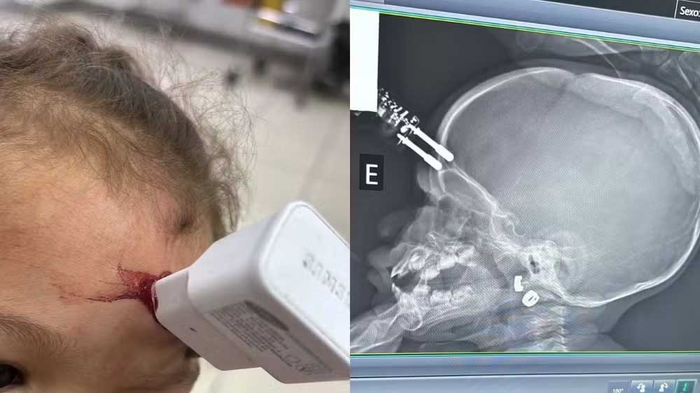 Menina de um ano fica com carregador de celular cravado na testa após cair da cama em Divinópolis