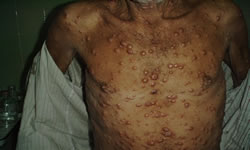 CTA passa a atender pacientes dos Programas de Tuberculose e Hanseníase