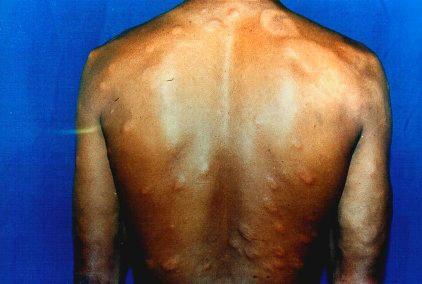 Oficina para agentes de saúde para a identificação precoce da hanseníase em Itaberaba