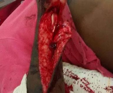 Homem fica gravemente ferido após briga com facão em Itaberaba